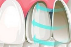 牙齒貼面可以維持多久？牙齒貼面能用多久？[圖]