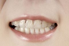 美白牙貼有用嗎？用牙貼真的能變白嗎？[圖]