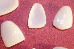 牙齒貼面是什么意思？牙齒貼面好不好？[圖]