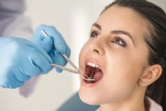 拔智齒出血多久算正常？拔智齒會出血多長時間？[圖]