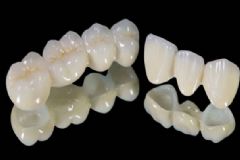 烤瓷牙和全瓷牙區(qū)別有哪些？全瓷牙和烤瓷牙哪個好？[圖]