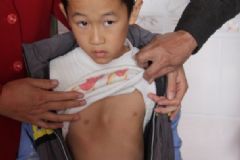 佝僂病缺乏什么元素？佝僂病缺少什么維生素？[圖]