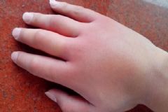 喝水臉腫怎么辦？喝水水腫怎么消除？[圖]