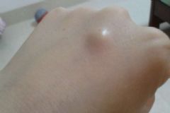 腱鞘炎有幾種？腱鞘炎分幾種？[圖]