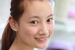 18歲臉上長了青春痘怎么辦？青春痘怎么治療？[多圖]
