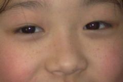 17歲臉上長(zhǎng)斑的原因？17歲臉上有斑怎么辦？[多圖]