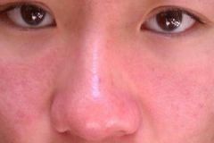 皮膚過敏臉腫了怎么辦？皮膚過敏治療小妙招[圖]