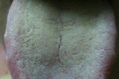 口臭舌苔厚黃什么原因？舌苔厚黃口臭怎么治？[圖]