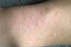 皮膚濕疹是怎么引起的？皮膚濕疹用什么藥？[圖]