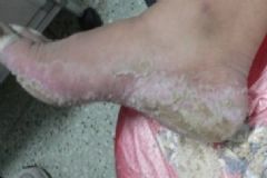 腳臭脫皮還癢什么東西能夠去除？腳臭脫皮癢怎么辦？[圖]