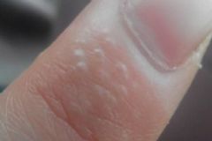 小水泡濕疹怎么治療？腳上起小水泡濕疹怎么辦？[圖]