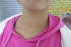 甲狀腺結(jié)節(jié)會(huì)自愈嗎？甲狀腺結(jié)節(jié)如何治療？[圖]