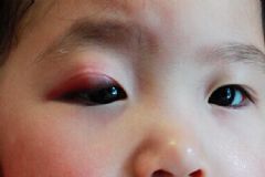 上眼皮腫了是怎么回事？上眼皮紅腫癢是怎么回事？[多圖]