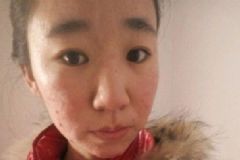 青少年怎樣祛痘？青少年長(zhǎng)痘如何祛除？[多圖]