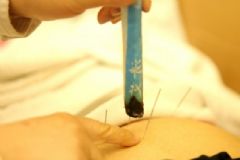 針灸可以調(diào)理月經(jīng)嗎？針灸調(diào)理月經(jīng)好嗎？[多圖]