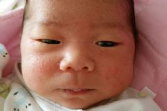 濕疹可以洗澡嗎？濕疹洗澡好還是不好？[多圖]