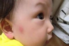 蚊子叮的癢怎么辦？蚊子叮的大包怎么辦？[多圖]