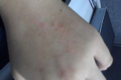 吹空調(diào)會(huì)過(guò)敏嗎？吹空調(diào)過(guò)敏了怎么辦？[多圖]