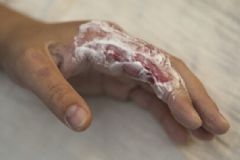 燙到了怎么辦？燙到了可以抹牙膏嗎？[多圖]