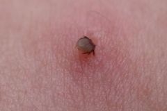 被蜱蟲咬了有什么癥狀？被蜱蟲咬了怎么辦？[多圖]