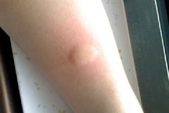蚊子咬了怎么消腫止癢最快？蚊子咬的紅點怎么快速消除？[多圖]