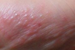 夏天腳上起水泡怎么辦？夏天腳上長(zhǎng)水泡很癢怎么辦？[多圖]