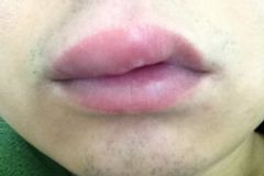 吃桃子嘴巴癢 吃桃子嘴腫了怎么辦？[多圖]