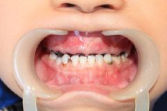 青少年有蛀牙怎么辦？容易長(zhǎng)蛀牙的原因是什么？[多圖]