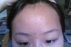 青少年頭上長(zhǎng)痘痘什么原因？頭上長(zhǎng)痘痘怎么辦？[多圖]