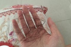 秋天為什么會掉頭發(fā)？秋天頭發(fā)掉的很厲害怎么辦？[多圖]