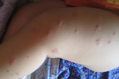 清明節(jié)前后謹防丘疹性蕁麻疹 春季出游注意丘疹性蕁麻疹[多圖]