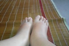 夏天腳腫是怎么回事？夏天腳腫怎么辦？[多圖]