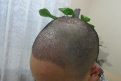 植發(fā)靠譜嗎？植發(fā)到底有什么好處？[多圖]