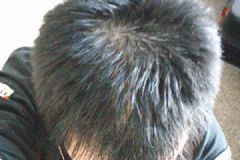 預(yù)防脫發(fā)的方法有哪些？預(yù)防脫發(fā)有哪些妙招？[多圖]