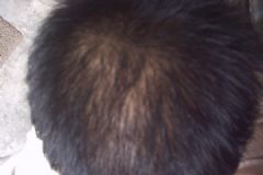 節(jié)食會導致脫發(fā)嗎？導致脫發(fā)有哪些原因？[多圖]