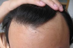 引起脫發(fā)的原因是什么？是什么導致男性脫發(fā)？[多圖]