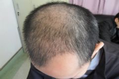 脫發(fā)的癥狀有哪些？男性脫發(fā)的表現(xiàn)是什么？[多圖]