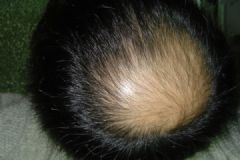 導(dǎo)致男人脫發(fā)的原因是什么？男人脫發(fā)的原因有哪些？[多圖]