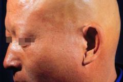 斑禿脫發(fā)有哪些癥狀？斑禿脫發(fā)的表現(xiàn)是什么？[多圖]