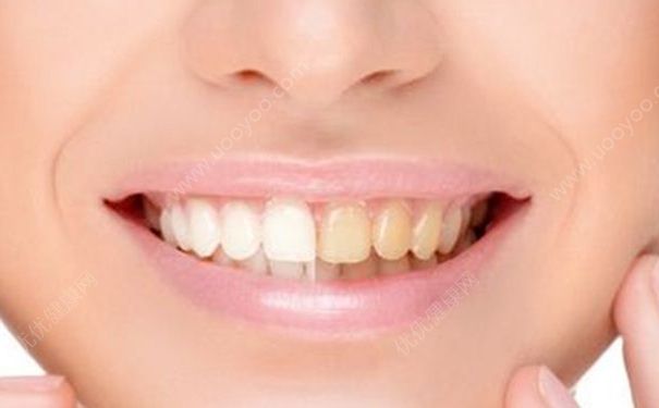吃什么會導致牙齒變黃？哪些食物吃了會導致牙齒變黃？(1)