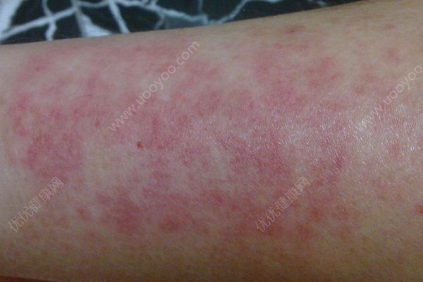 南瓜容易過敏嗎？吃南瓜會過敏嗎？(1)