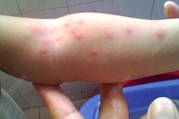 南瓜容易過敏嗎？吃南瓜會過敏嗎？(2)