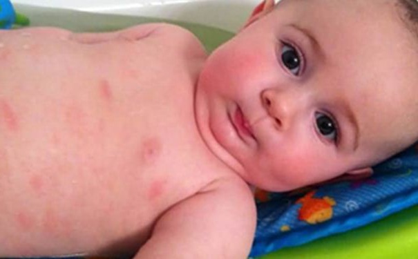 寶寶母乳過敏有哪些癥狀？寶寶母乳過敏有什么癥狀？(1)