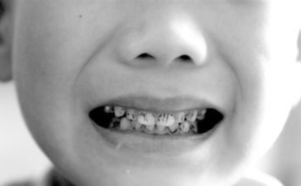 小孩子如何長(zhǎng)一口好牙？孩子怎么長(zhǎng)好牙？(1)