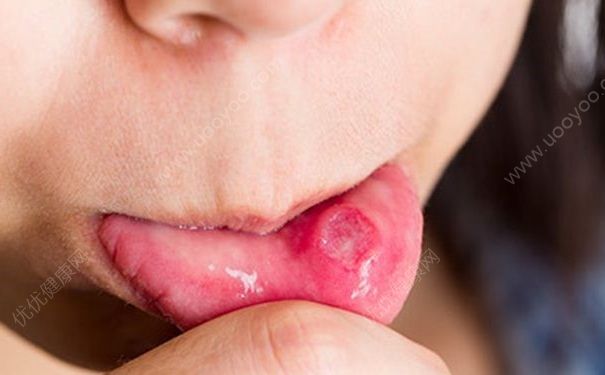 夏季上火分哪些類型？夏季上火盲目買藥會誘發(fā)疾病嗎？(1)