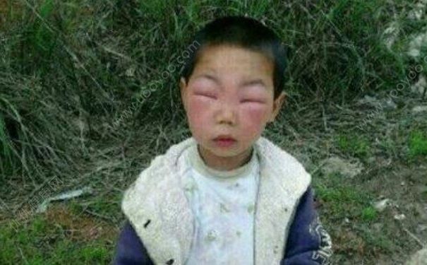 小孩捅馬蜂窩小狗忠心護(hù)主，都被蜇腫了臉，被馬蜂蜇了怎么辦？(1)