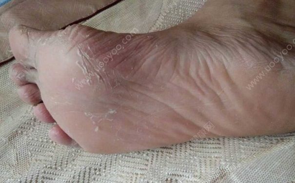 夏天腳脫皮發(fā)癢怎么回事？夏天腳脫皮起泡怎么辦？(2)