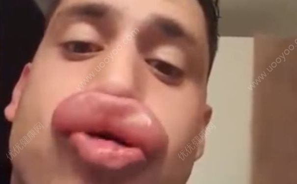 無敵香腸嘴重出江湖，被馬蜂蜇了該怎么辦？(1)
