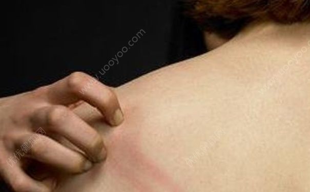 冰黃膚樂軟膏有激素嗎？冰黃膚樂軟膏能涂臉嗎？(1)