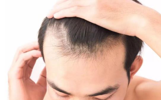 男人脫發(fā)怎么辦？男人脫發(fā)是什么原因引起的